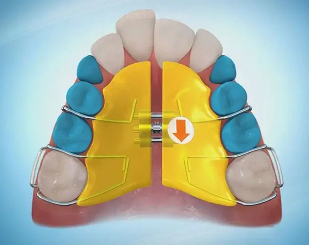 子どもの矯正 拡大装置