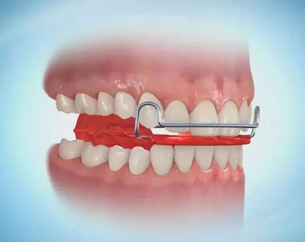 バイオネーター