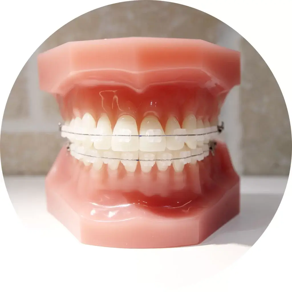 ワイヤーを用いた矯正治療写真